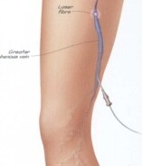 Endovenous laser ablation